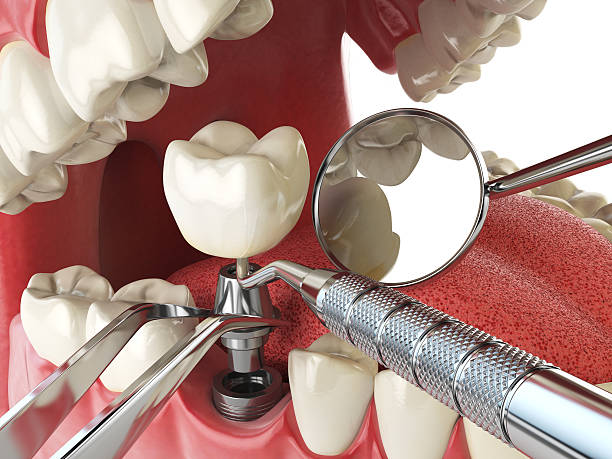 Best Emergency Treatment for Dental Infections or Abscesses in Aventura, FL